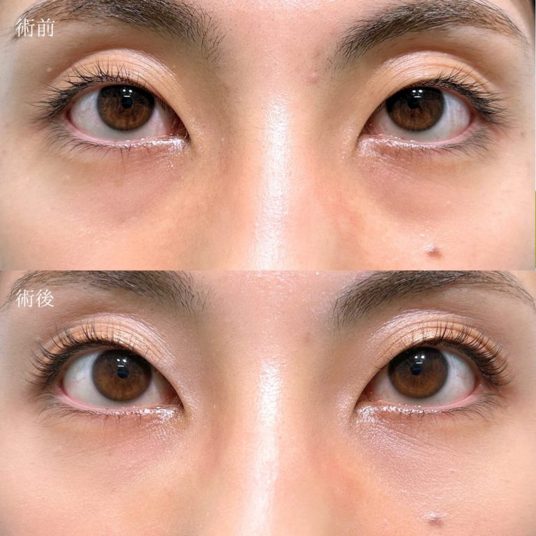 切らない目の下のクマ取り・目の下のたるみ（ふくらみ）取り(担当医:三好 翔輝 医師)の症例写真1