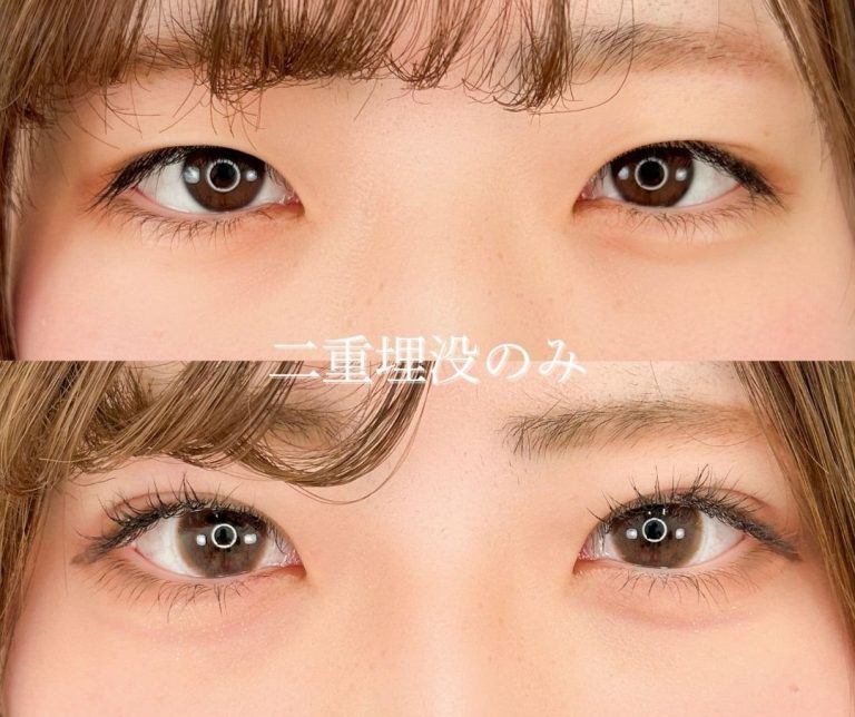 二重埋没法(担当医:岡本 卓也 医師)の症例写真1