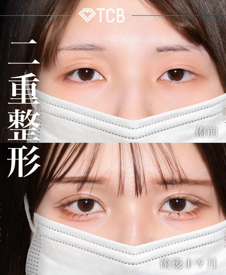 二重埋没法(担当医:岡本 卓也 医師)の症例写真2