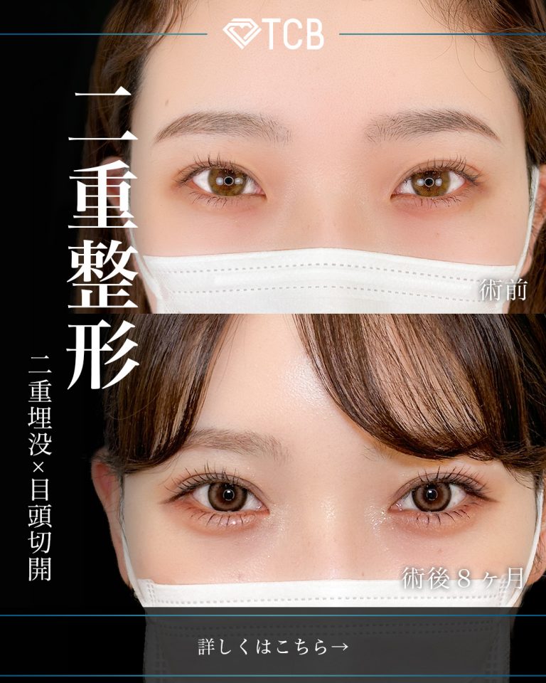 目頭切開(担当医:岡本 卓也 医師)の症例写真1