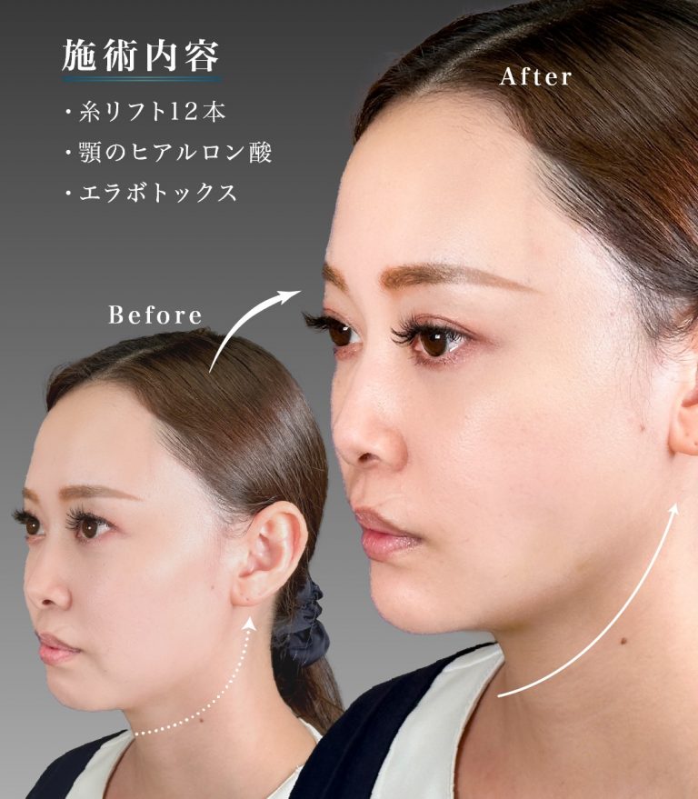 小顔美肌再生（リフトアップ）(担当医:岡本 卓也 医師)の症例写真2