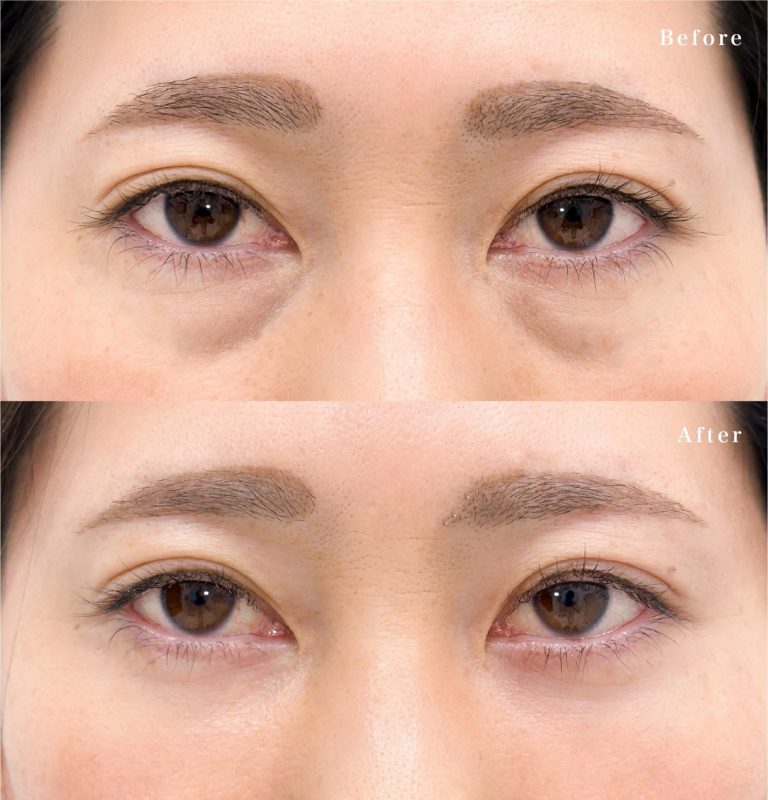 切らない目の下のクマ取り・目の下のたるみ（ふくらみ）取り(担当医:岡本 卓也 医師)の症例写真1