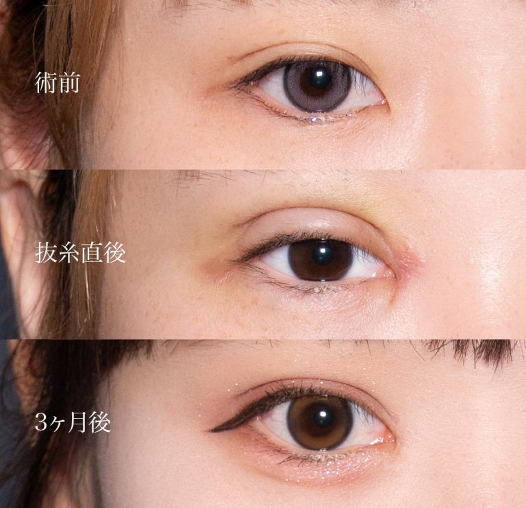 目頭切開(担当医:岡本 卓也 医師)の症例写真3