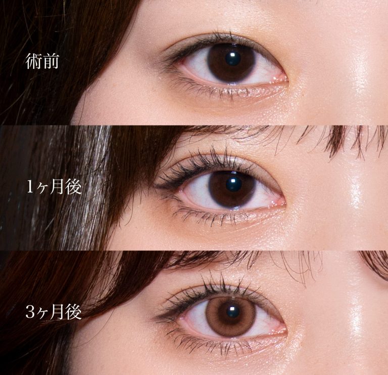 グラマラスライン形成（たれ目形成）(担当医:岡本 卓也 医師)の症例写真3