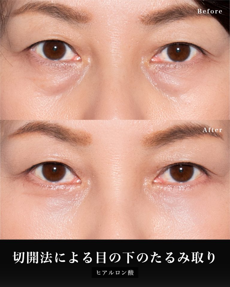 切開法による目の下のたるみ取り（下眼瞼除皺術）(担当医:岡本 卓也 医師)の症例写真2