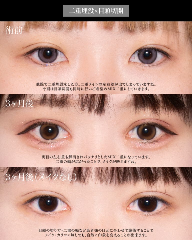 目頭切開(担当医:岡本 卓也 医師)の症例写真1