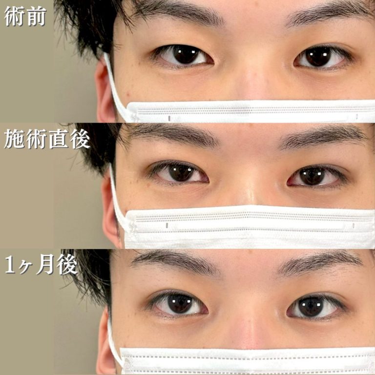 二重埋没法(担当医:花岡 拓也 医師)の症例写真1