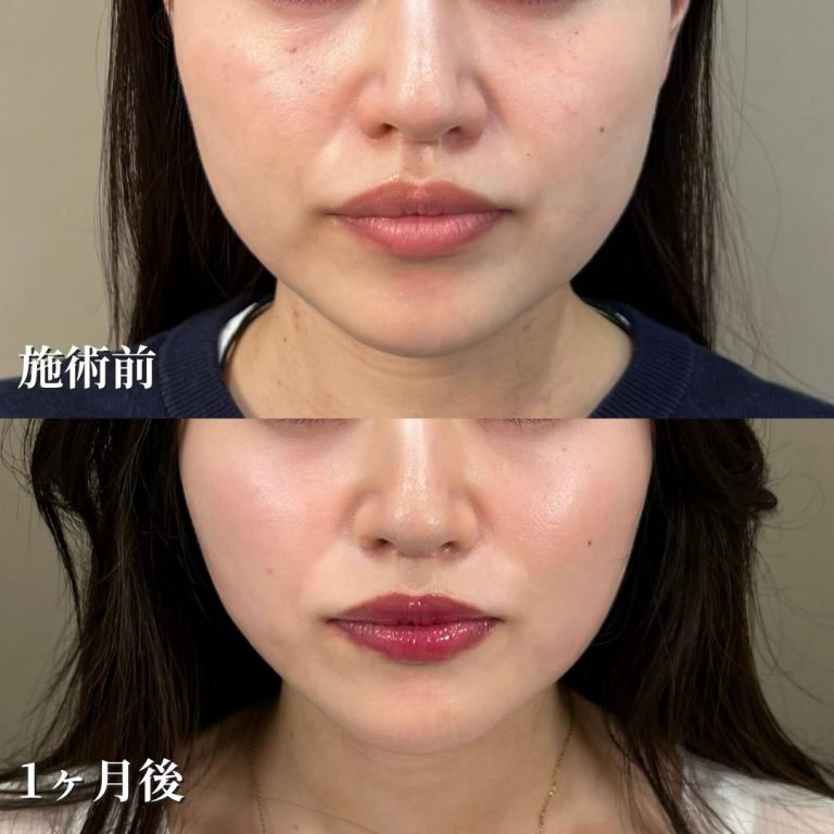 小顔美肌再生（リフトアップ）(担当医:花岡 拓也 医師)の症例写真2