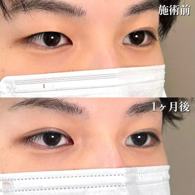 二重埋没法(担当医:花岡 拓也 医師)の症例写真2