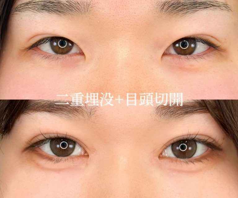 目頭切開(担当医:岡本 卓也 医師)の症例写真1