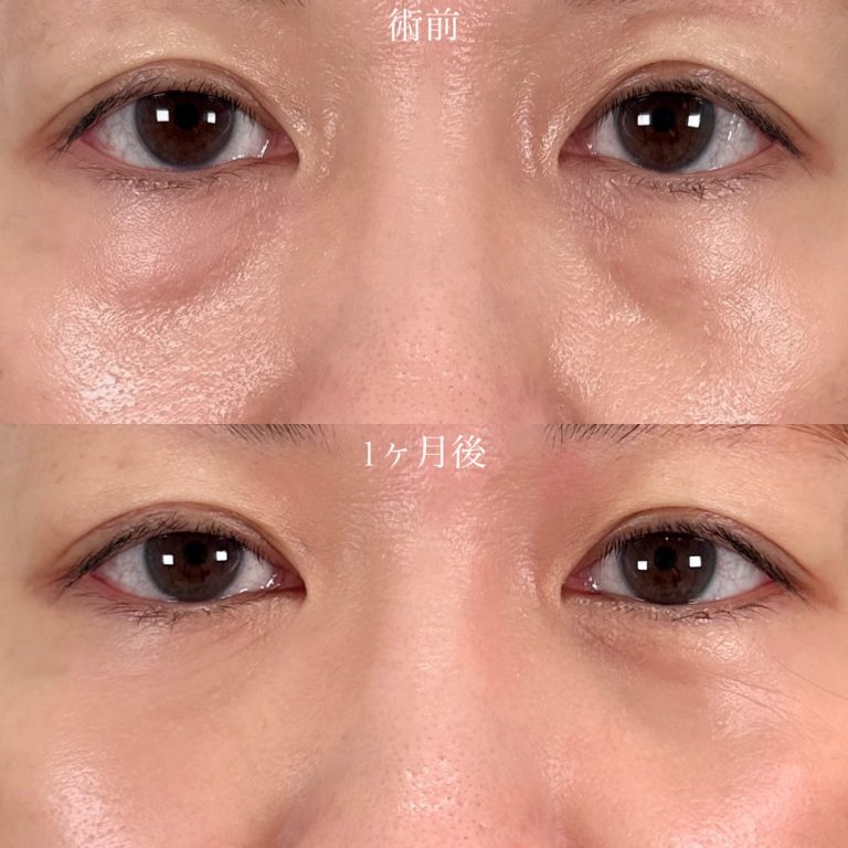 切らない目の下のクマ取り・目の下のたるみ（ふくらみ）取り(担当医:山口 征大 医師)の症例写真1