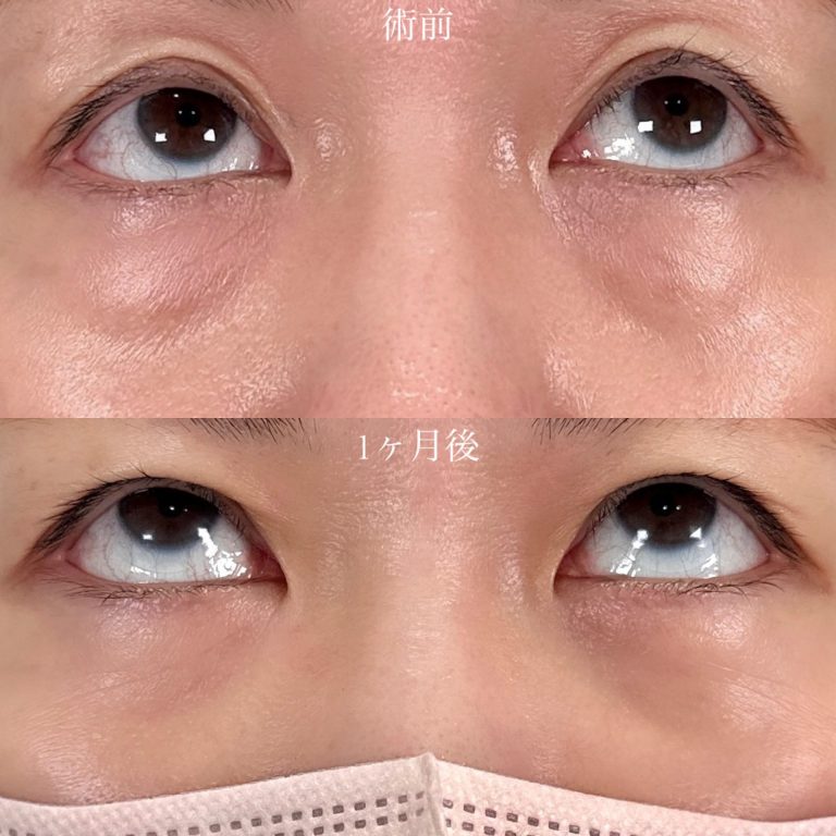 切らない目の下のクマ取り・目の下のたるみ（ふくらみ）取り(担当医:山口 征大 医師)の症例写真2