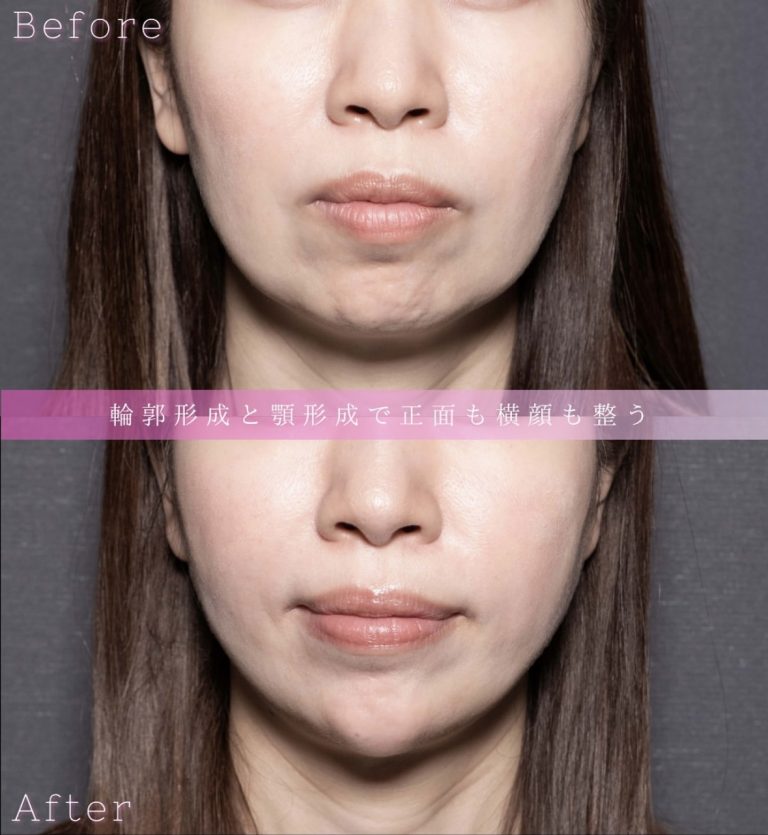 顔の脂肪吸引(担当医:北村 可恋 医師)の症例写真1