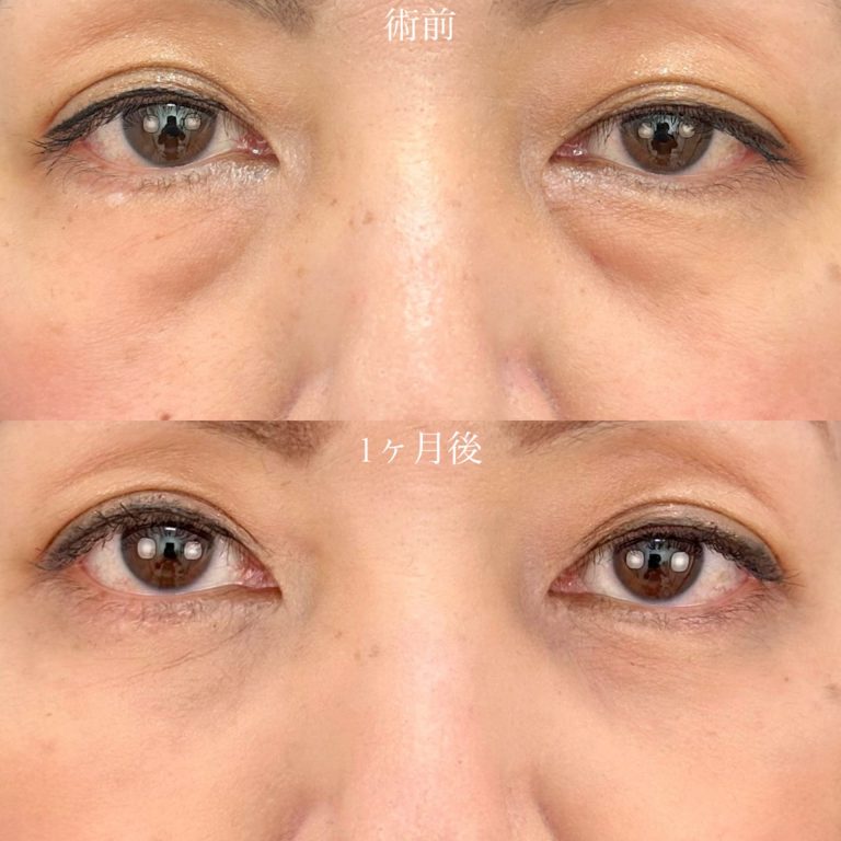 切らない目の下のクマ取り・目の下のたるみ（ふくらみ）取り(担当医:山口 征大 医師)の症例写真1