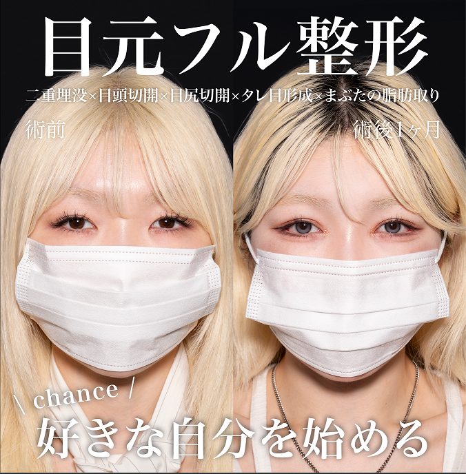 グラマラスライン形成（たれ目形成）(担当医:岡本 卓也 医師)の症例写真1