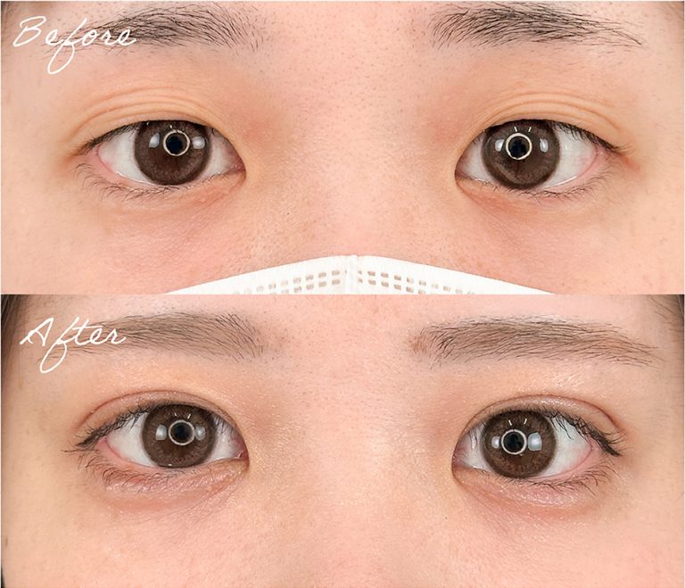 二重埋没法(担当医:岡本 卓也 医師)の症例写真1