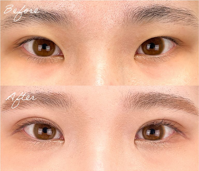 二重埋没法(担当医:岡本 卓也 医師)の症例写真1