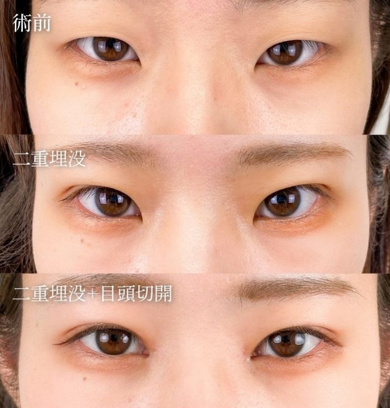 目頭切開(担当医:岡本 卓也 医師)の症例写真1