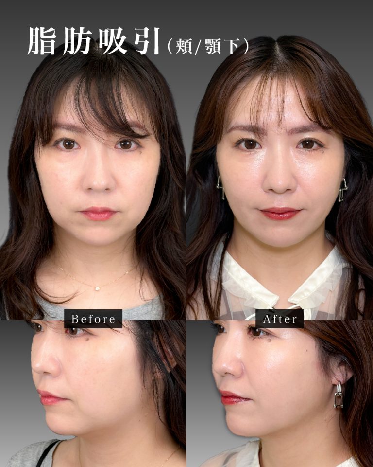 顔の脂肪吸引(担当医:岡本 卓也 医師)の症例写真4