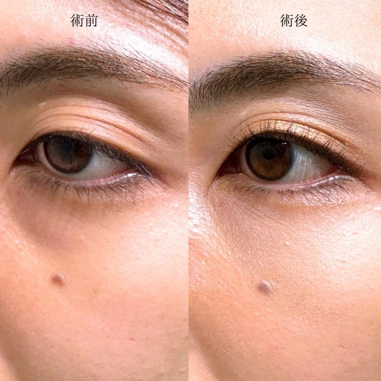 切らない目の下のクマ取り・目の下のたるみ（ふくらみ）取り(担当医:三好 翔輝 医師)の症例写真2