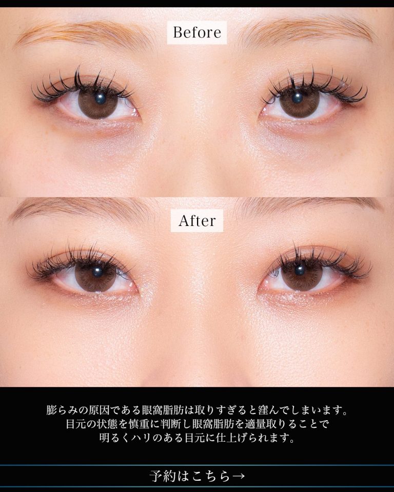 切らない目の下のクマ取り・目の下のたるみ（ふくらみ）取り(担当医:岡本 卓也 医師)の症例写真2