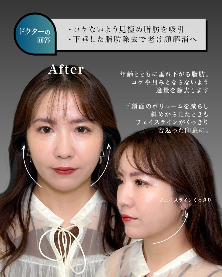 顔の脂肪吸引(担当医:岡本 卓也 医師)の症例写真3