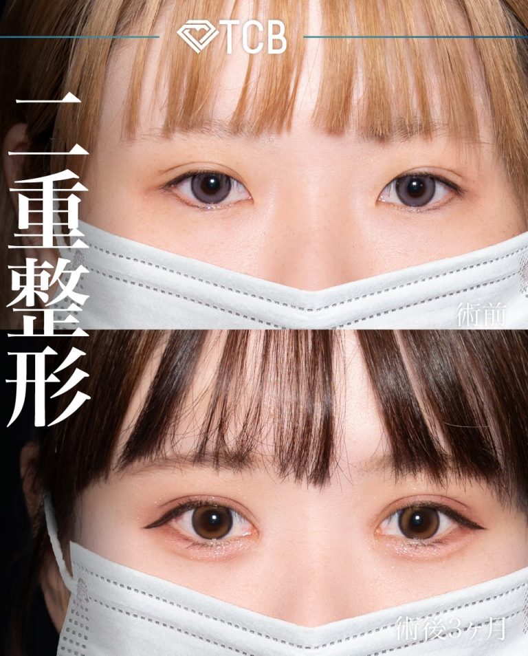 目頭切開(担当医:岡本 卓也 医師)の症例写真2