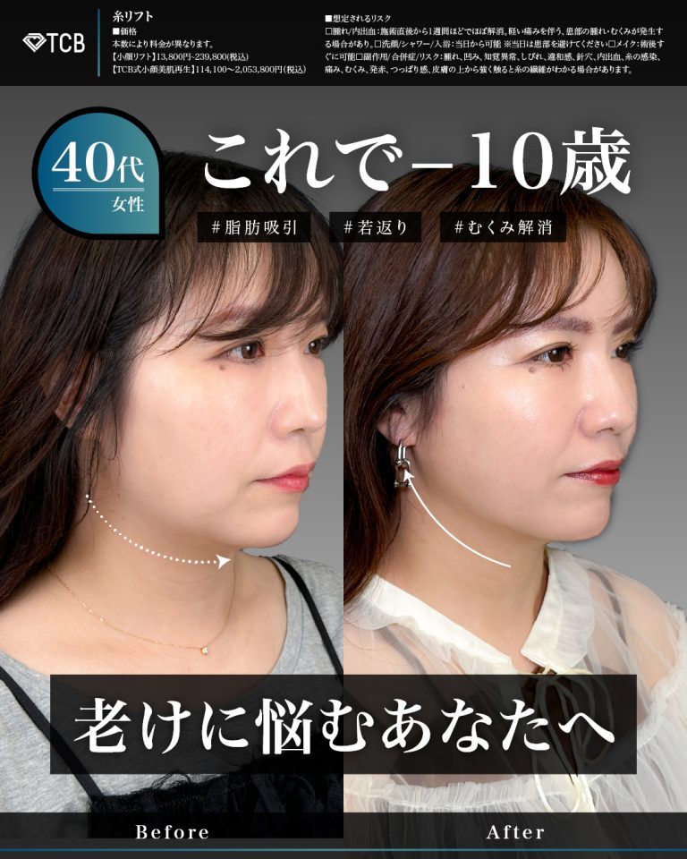 顔の脂肪吸引(担当医:岡本 卓也 医師)の症例写真1