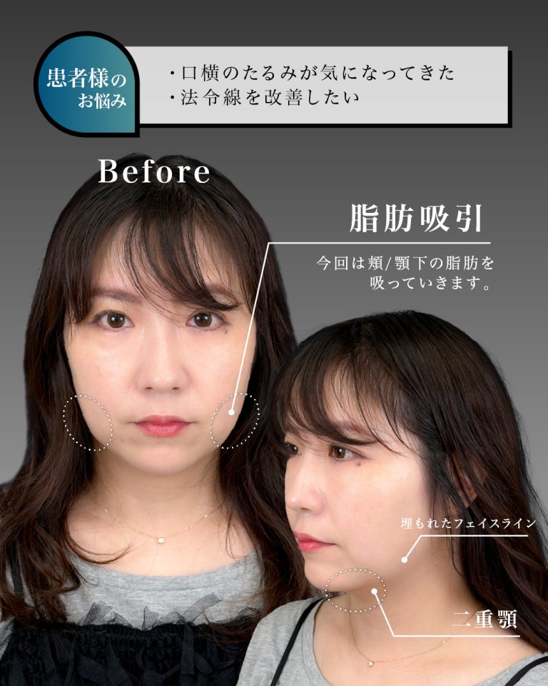 顔の脂肪吸引(担当医:岡本 卓也 医師)の症例写真2