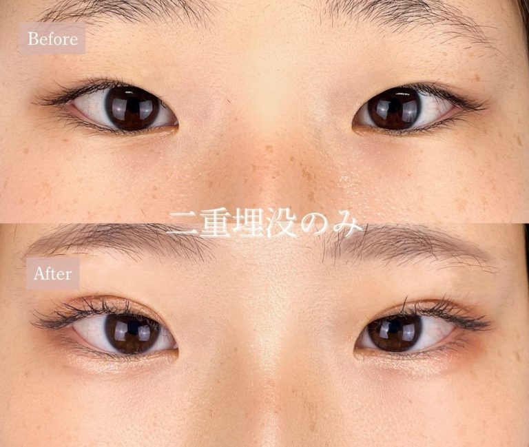 二重埋没法(担当医:岡本 卓也 医師)の症例写真1