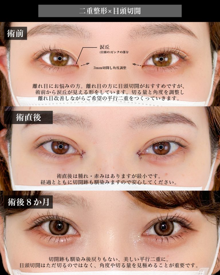 目頭切開(担当医:岡本 卓也 医師)の症例写真2