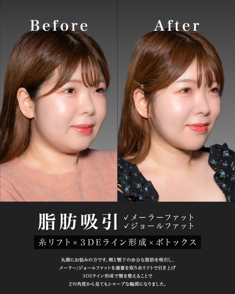 顔の脂肪吸引(担当医:岡本 卓也 医師)の症例写真2
