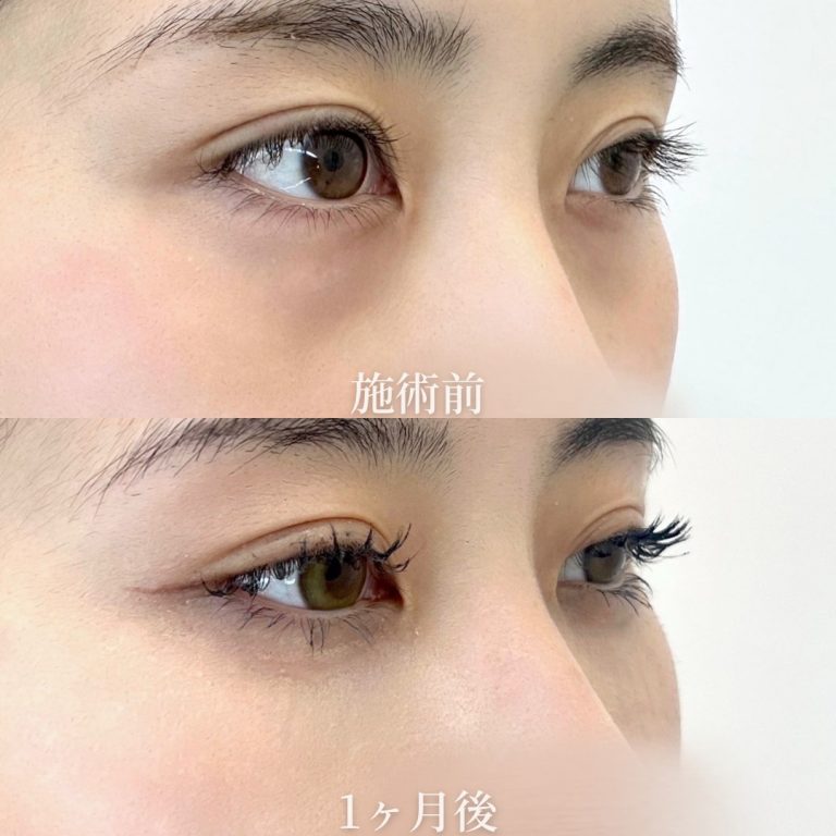 切らない目の下のクマ取り・目の下のたるみ（ふくらみ）取り(担当医:垣花 瑠美子 医師)の症例写真2