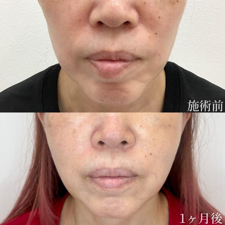 小顔美肌再生（リフトアップ）(担当医:垣花 瑠美子 医師)の症例写真1