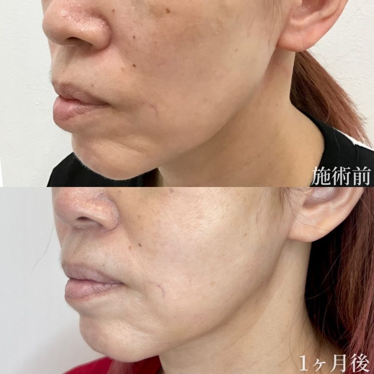 小顔美肌再生（リフトアップ）(担当医:垣花 瑠美子 医師)の症例写真2