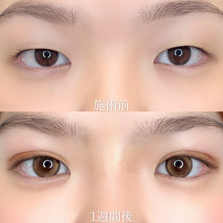 二重埋没法(担当医:垣花 瑠美子 医師)の症例写真1