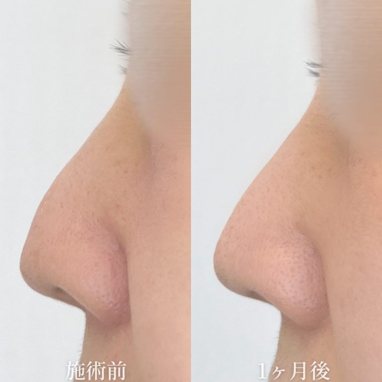 鼻尖形成(担当医:垣花 瑠美子 医師)の症例写真1