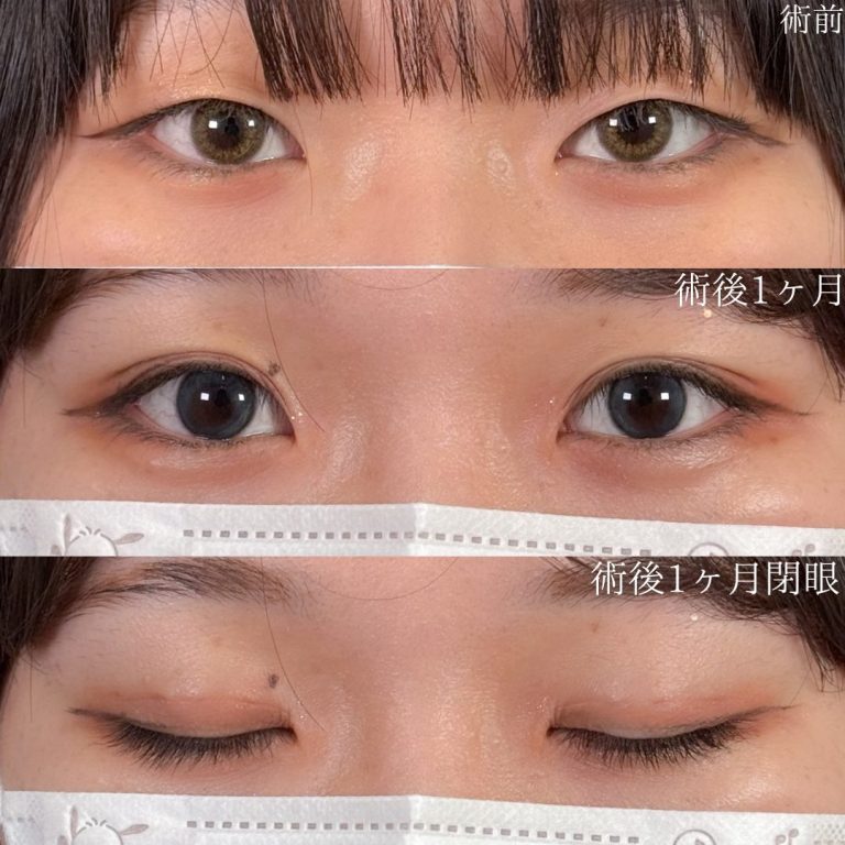 二重埋没法(担当医:佐野 孝治 医師)の症例写真1