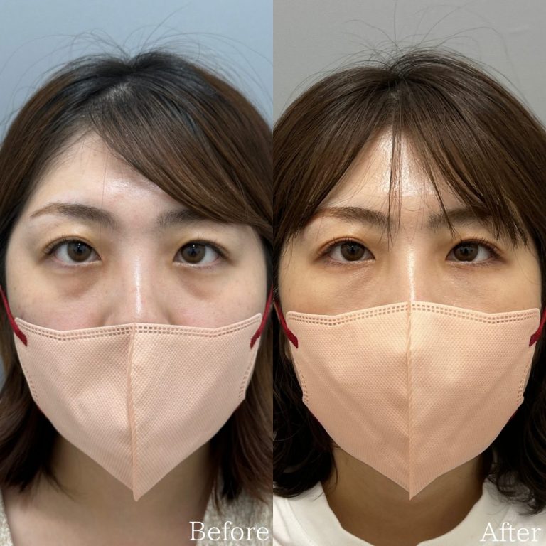 切らない目の下のクマ取り・目の下のたるみ（ふくらみ）取り(担当医:佐野 孝治 医師)の症例写真1