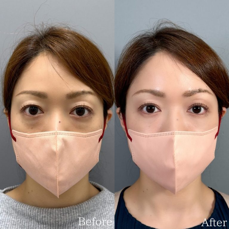 切らない目の下のクマ取り・目の下のたるみ（ふくらみ）取り(担当医:佐野 孝治 医師)の症例写真1