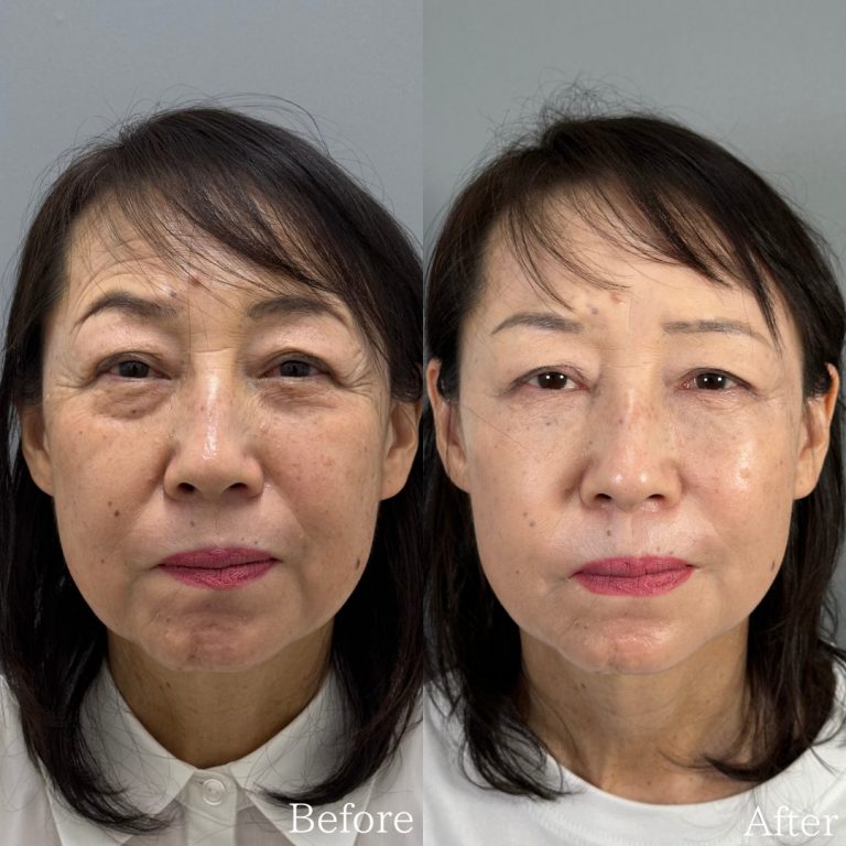 切らない目の下のクマ取り・目の下のたるみ（ふくらみ）取り(担当医:佐野 孝治 医師)の症例写真1