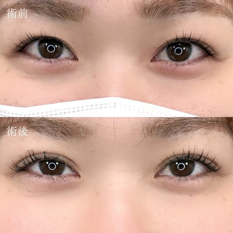 二重埋没法(担当医:三好 翔輝 医師)の症例写真1