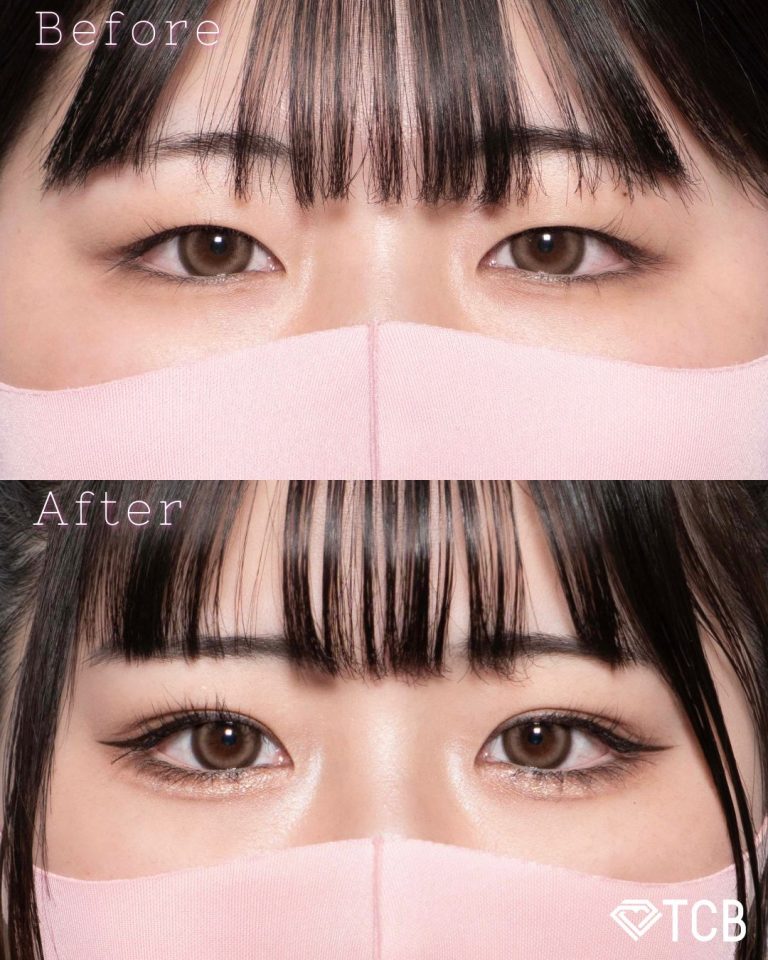 二重埋没法(担当医:北村 可恋 医師)の症例写真1