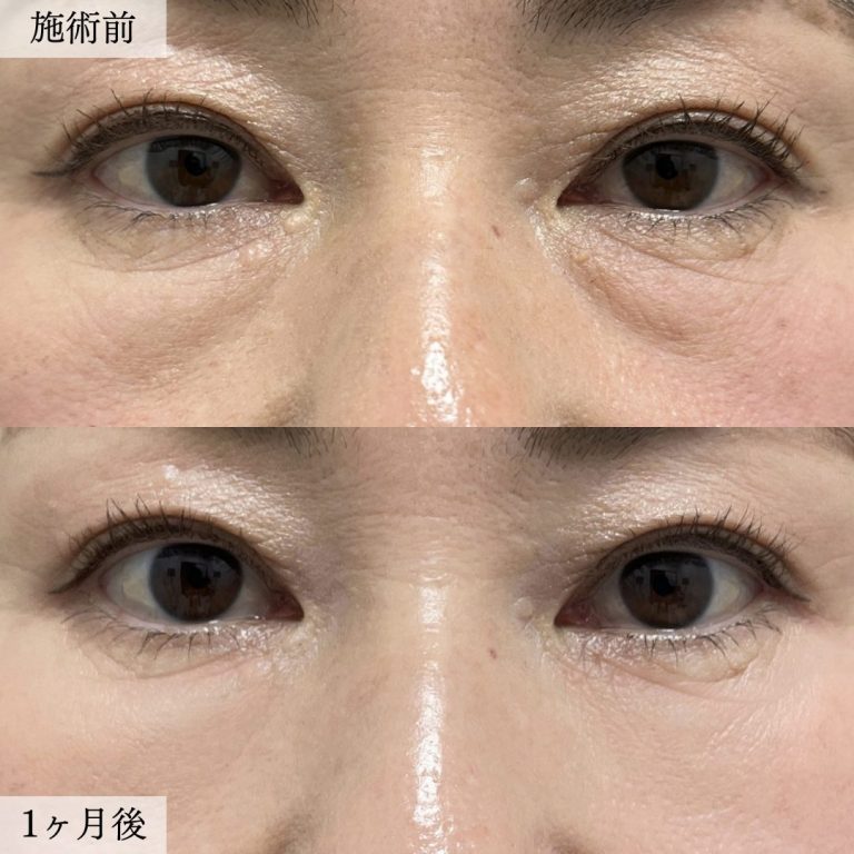 切らない目の下のクマ取り・目の下のたるみ（ふくらみ）取り(担当医:大見 貴秀 医師)の症例写真1