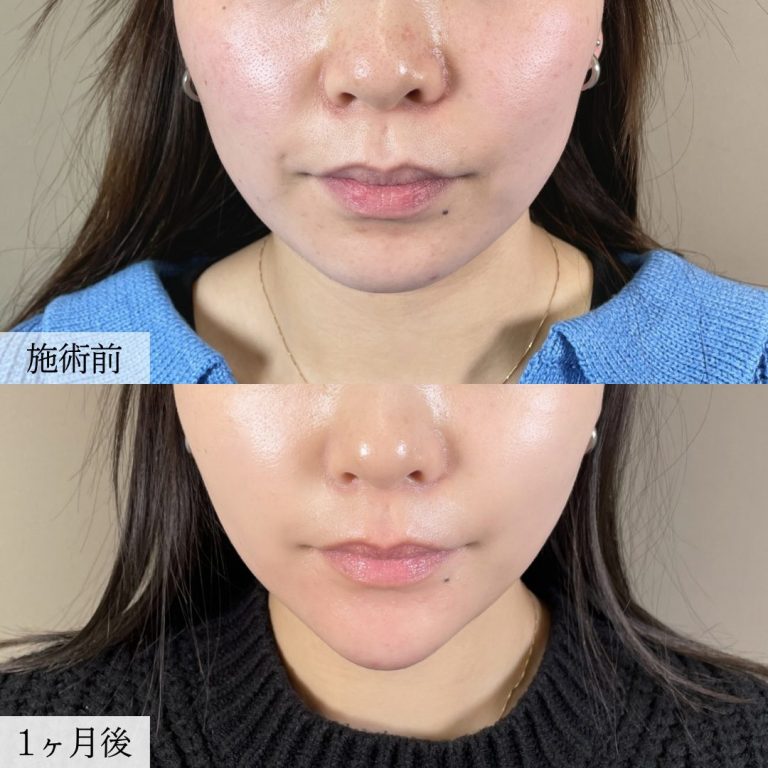 顔の脂肪吸引(担当医:大見 貴秀 医師)の症例写真1