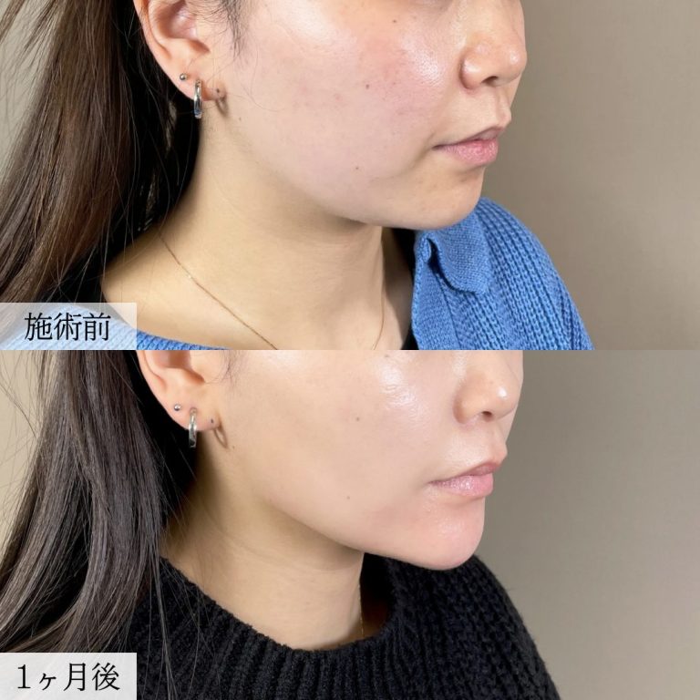 顔の脂肪吸引(担当医:大見 貴秀 医師)の症例写真2