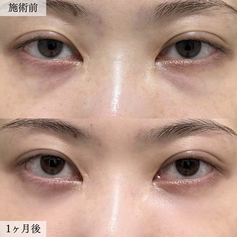 切らない目の下のクマ取り・目の下のたるみ（ふくらみ）取り(担当医:大見 貴秀 医師)の症例写真1