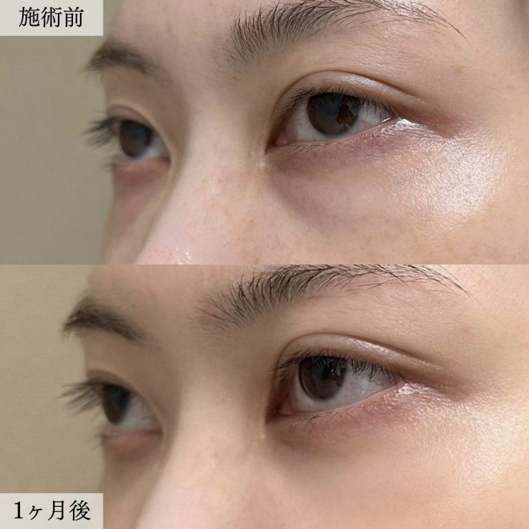 切らない目の下のクマ取り・目の下のたるみ（ふくらみ）取り(担当医:大見 貴秀 医師)の症例写真2