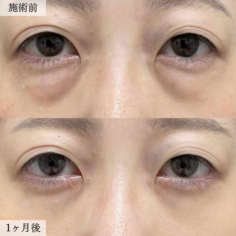 切らない目の下のクマ取り・目の下のたるみ（ふくらみ）取り(担当医:大見 貴秀 医師)の症例写真1
