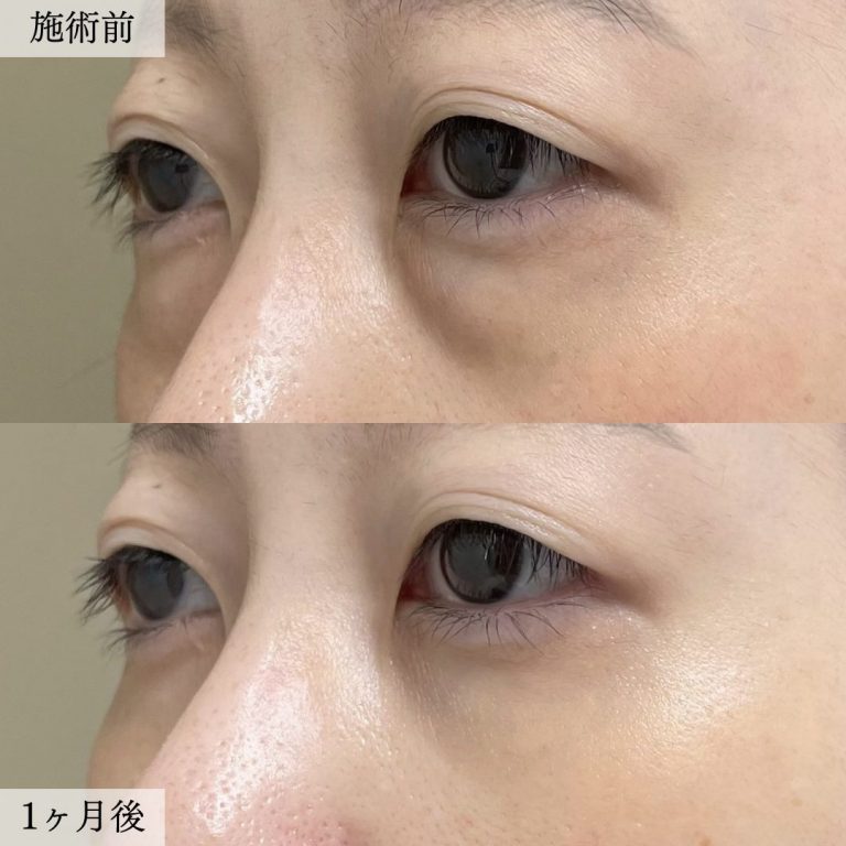 切らない目の下のクマ取り・目の下のたるみ（ふくらみ）取り(担当医:大見 貴秀 医師)の症例写真2